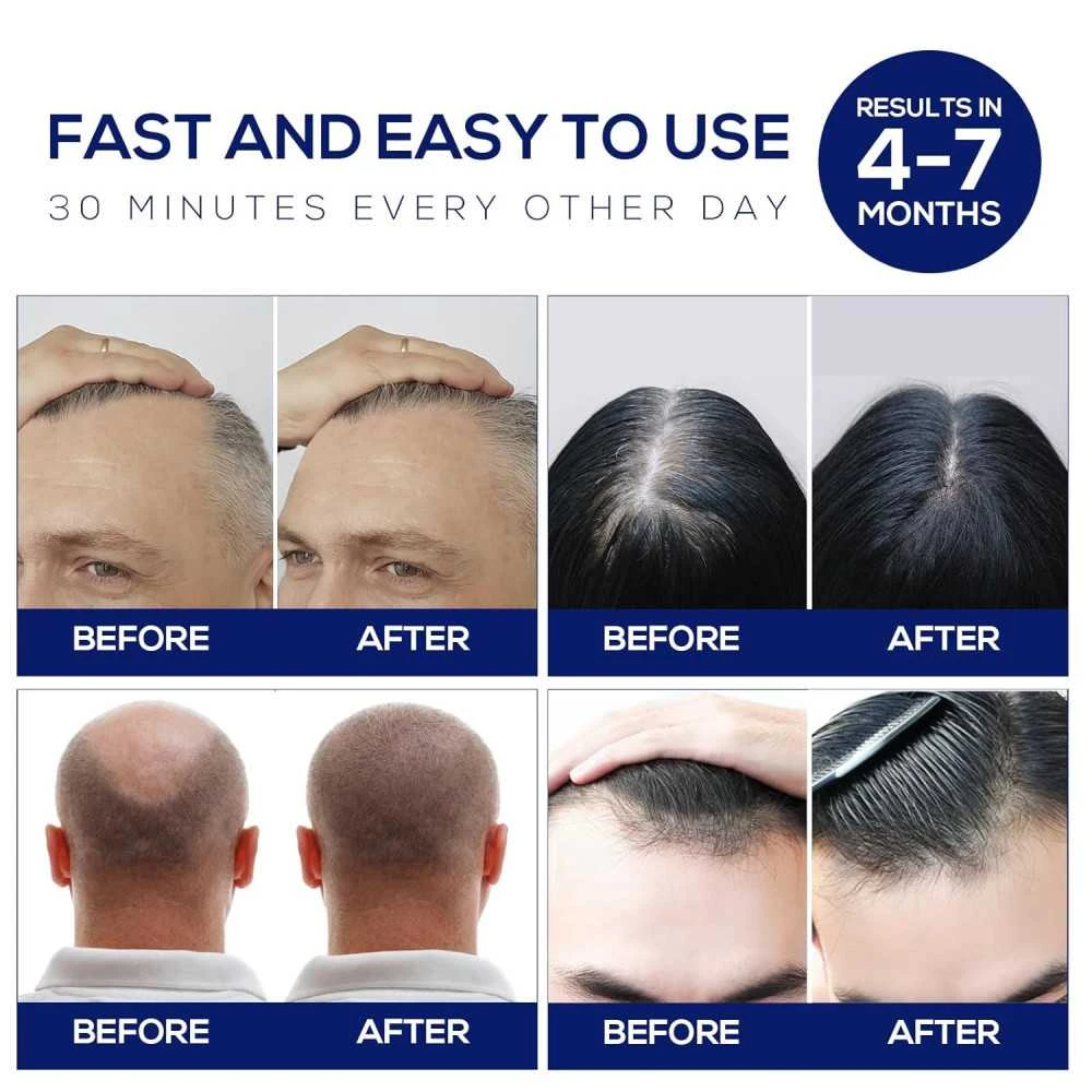 Advanced Laser Hair Growth Cap For Men And Women - Effective Red Light Therapy For Hair Regrowth, Portable And Easy To Use 7 Advanced Laser Hair Growth Cap For Men And Women - Effective Red Light Therapy For Hair Regrowth, Portable And Easy To Use - Image 5