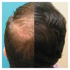 Capillus82 Laser Therapy Cap - FDA Cleared, Effective Hair Regrowth Solution -Home Electronics Store capillusultra mobile laser therapy cap for hair regrowth new 6 minute flexible fitting model 7