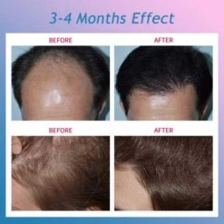 CNV Advanced Hair Regrowth System: Revitalize Your Hair -Home Electronics Store cnv hair growth helmet advanced light therapy for thicker healthier hair 3