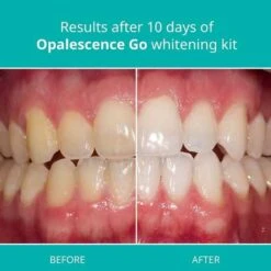Opalescence Go 10 Mint: Easy Teeth Whitening Prefilled Trays -Home Electronics Store opalescence go the teeth whitening trays 10 hydrogen 4